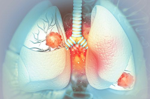 Health Impacts from Radon